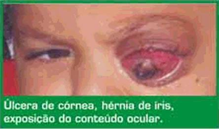 O RETINOBLASTOMA E CONDIES SCIO - ECONMICAS E CULTURAIS