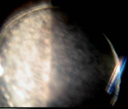  Detalhe da opacificao nas duas faces da lente